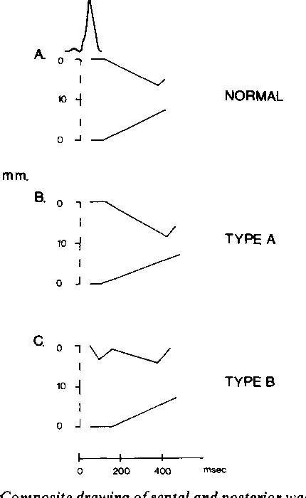 PDF An Echocardiographic Study Of Interventricular Septal Motion In