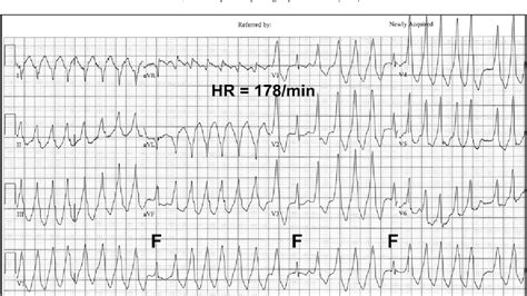 Figure 1 From Initial Evaluation And Management Of Wide Complex