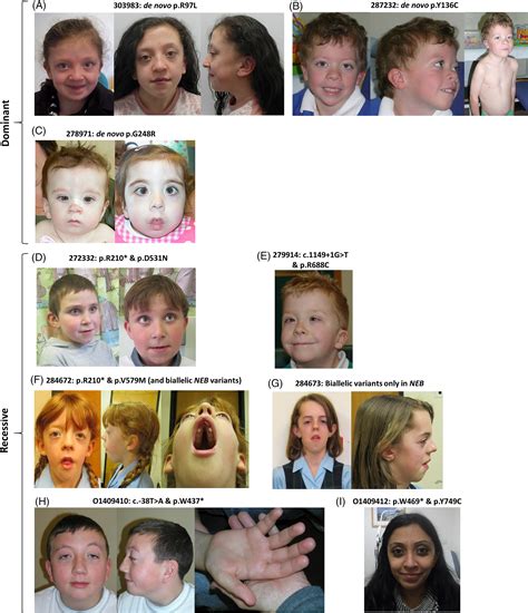 Delineation Of Dominant And Recessive Forms Of Lztr1‐associated Noonan