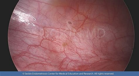 Bladder Endometriosis - Seckin Endometriosis Center