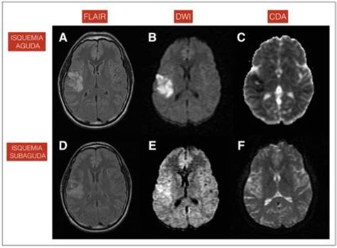 Figure 4 from Papel de la RM cerebral con secuencia de difusión más