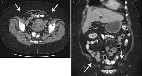 Cross Sectional Imaging Of The Abdominal Wall Radiology Key