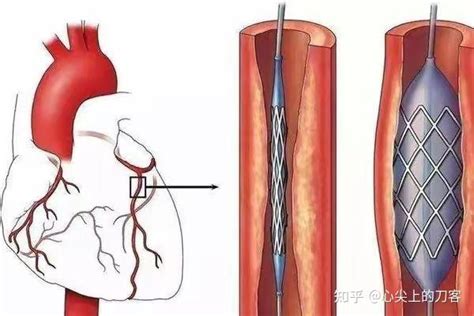 心脏搭桥心脏支架有什么优缺点冠心病患者到底该怎么选 知乎
