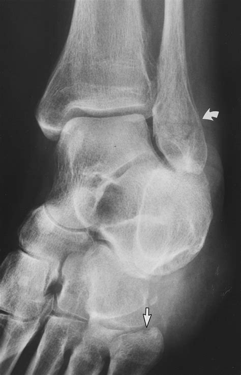 Avulsion Fracture Ankle