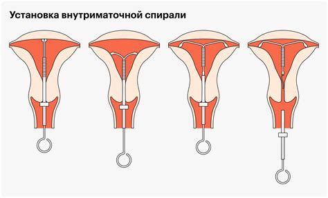 Внутриматочная спираль: сколько стоит установка, когда можно ставить ...