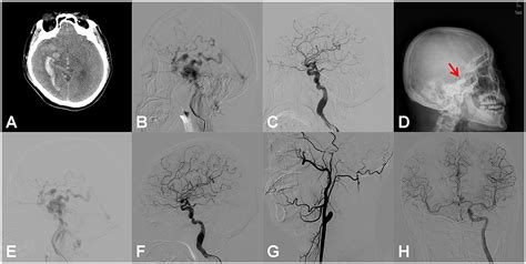 Frontiers Case Report Emergent Endovascular Treatment For Carotid Cavernous Fistulas