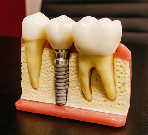 Dental Implants Essex, Available at CJ Dental Studio in Brentwood