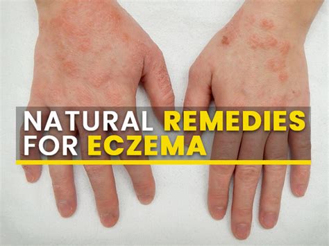 Home Remedies That Can Help Manage Eczema Symptoms - Boldsky.com