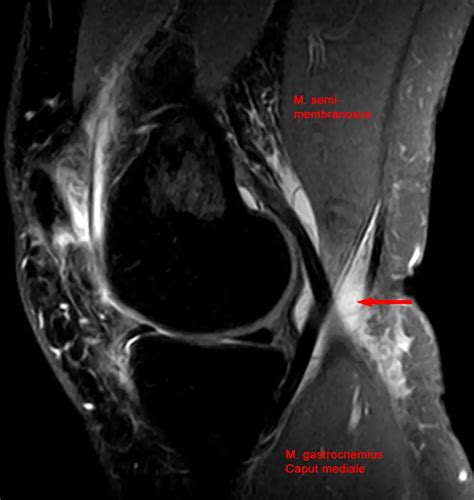 Baker’s Cyst: Causes, Symptoms, Treatments, and Massage - Massage ...