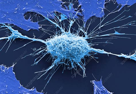 Cervical Cancer Cells Sem Stock Image C Science Photo