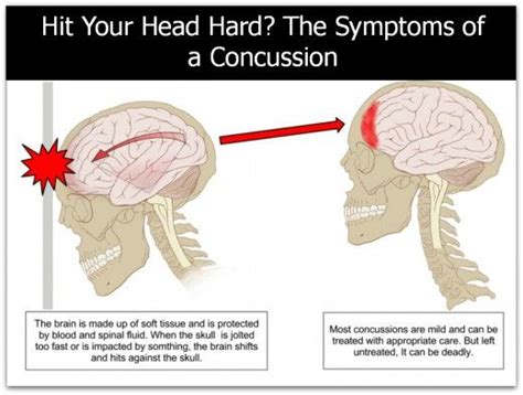 Concussion Symptoms And Care What I Learned From My Son S Experience