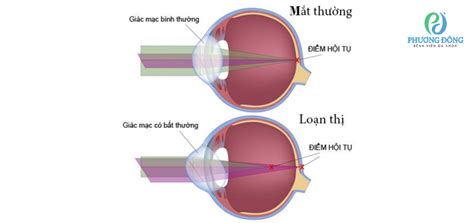 Loạn thị có điều trị được không và những điều cần biết