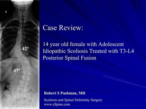 Case Review 12 14 Year Old Female With Adolescent Idiopathic