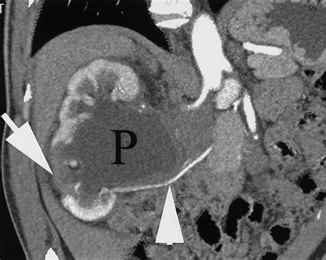 Adult Ureteropelvic Junction Obstruction Insights With Three Dimensional Multi Detector Row Ct