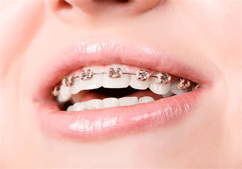 metal-braces – Maginnis Orthodontics