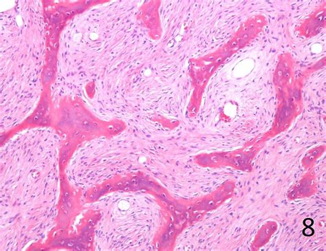 Polyostotic Fibrous Dysplasia Histology