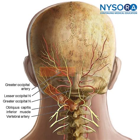 Cervical Plexus And Greater Occipital Nerve Blocks Controversies And Technique Update