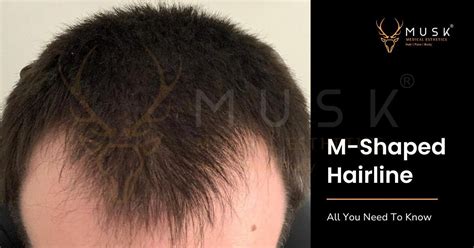 M-Shaped Hairline — All You Need To Know