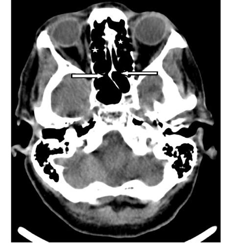 Sphenoethmoidal Recess