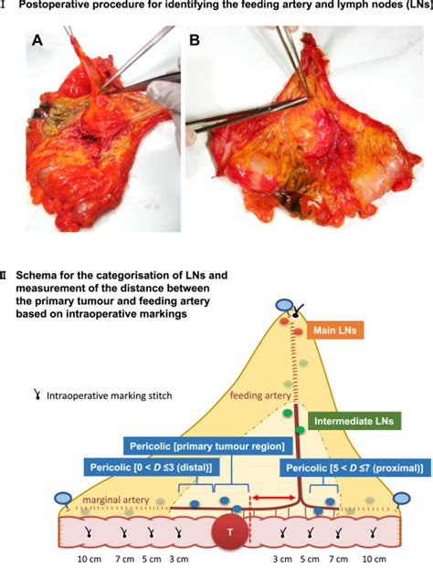 Optimal Bowel Resection Margin In Colon Cancer Surgery Prospective