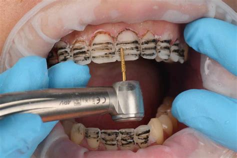 Minimally invasive anterior veneer restorations - SHINING 3D