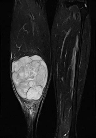 Myxoid Liposarcoma Soleus Muscle Radiology Case Radiopaedia Org