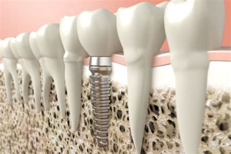 The Recovery Process after a Dental Bone Graft - Randal S. Elloway DDS ...