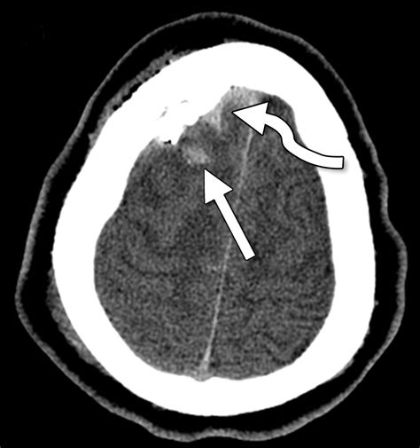 Traumatic Brain Injury Imaging Patterns And Complications Radiographics