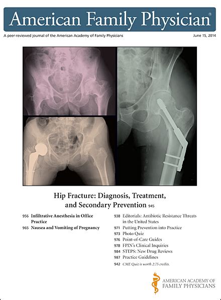 Hip Fracture