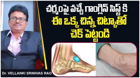 చర్మంపై వచ్చే గాంగ్లిన్ సిస్ట్ కి Remedy For Ganglion Cyst Ganglion Treatment Socialpost