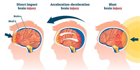 Aspetar Sports Concussion