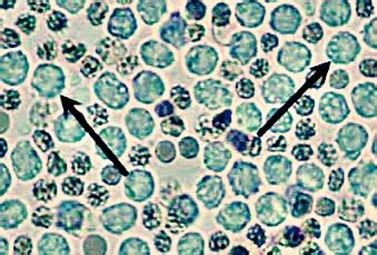 Leukocytes In Urine Normal Range