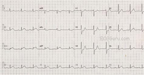 12 Lead STEMI Chart