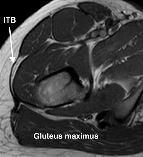 Gluteus Medius Tendinopathy Mri