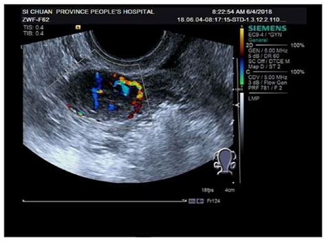 Color Doppler Ultrasound Image Of Patients With Positive Ovarian Sex Download Scientific