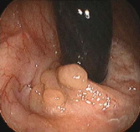 Figure 1 From Prevention Of Colorectal Cancer In High Risk Populations