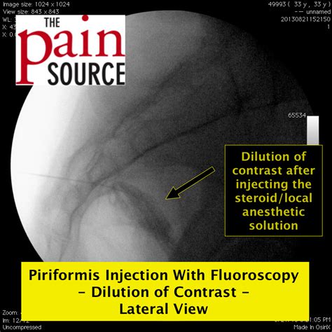 Piriformis Muscle Injection With Fluoroscopy - The Pain Source - Makes ...