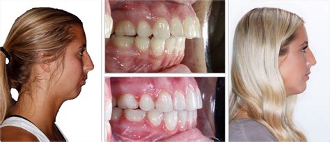 Before And After Braces Overjet