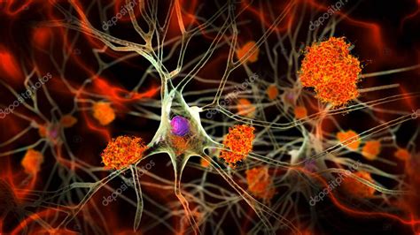 Neuronas En La Enfermedad De Alzheimer Ilustración 3d Que Muestra Placas Amiloides En Tejido