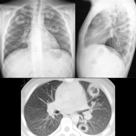 Pediatric Granulomatosis With Polyangiitis | Pediatric Radiology ...