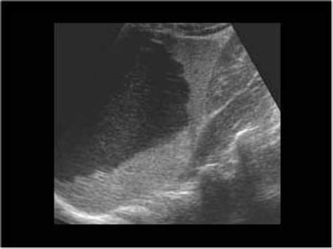 Wk 5 Spleen Pathology Large Splenic Cyst With Internal Relflections