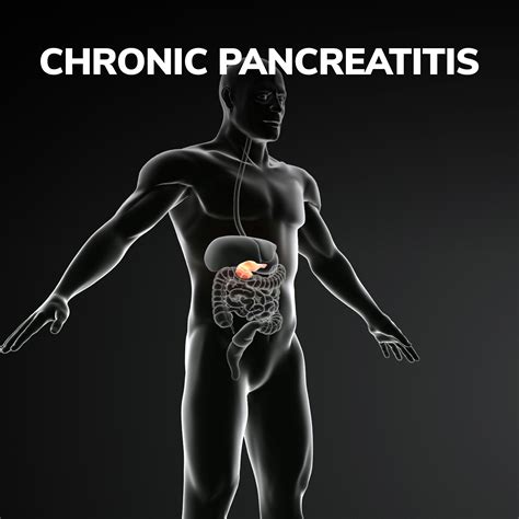 Chronic Pancreatitis Gastroenterology Of Greater Orlando