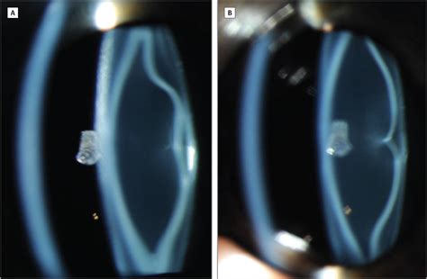 Congenital Lamellar Cataract Congenital Defects Jama Ophthalmology