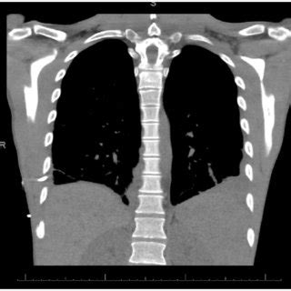 Chest Ct After Days Of Daptomycin Treatment There Is A Small