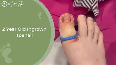 2 Year Old Ingrown Toenail YouTube