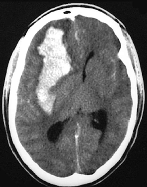 Brain Bleed: Brain Bleed Midline Shift