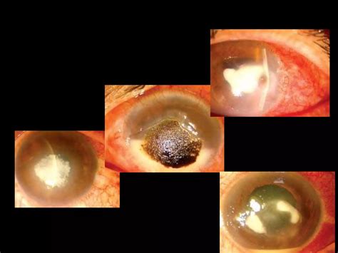 Corneal Ulcer Ppt