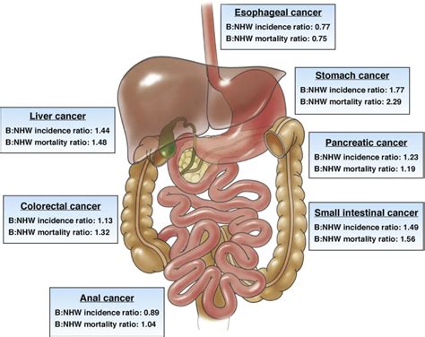 Racial Disparity In Gastrointestinal Cancer Risk Gastroenterology