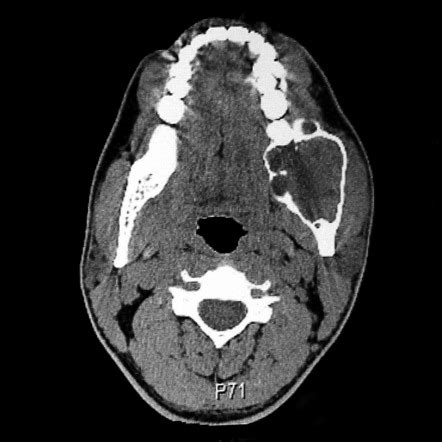 Odontogenic keratocyst | Radiology Reference Article | Radiopaedia.org