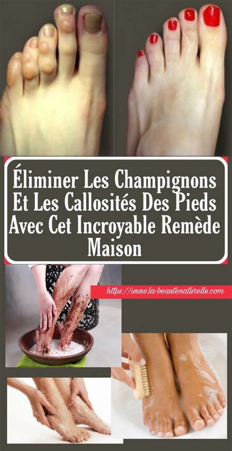 Éliminer les champignons et les callosités des pieds avec cet